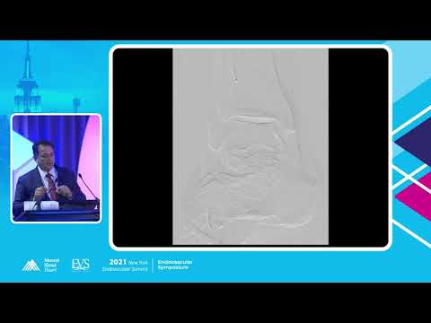 Complications and Bailouts Embolization Case 2 - Prakash Krishnan, MD
