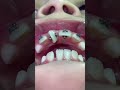 Orthodontist Reacts! INSANE Rotated Tooth! #Shorts