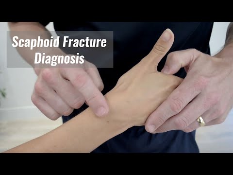 Scaphoid fracture diagnosis - Anatomical snuff box