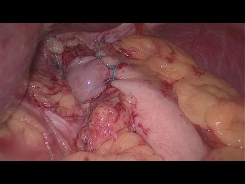 comment soigner une hernie hiatale oesophage