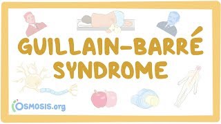 Guillain-Barre Syndrome - causes, symptoms, diagnosis, treatment, pathology