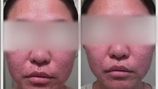 Rosacea treatment and care
