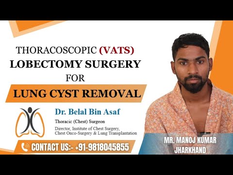 Patient Experience: Thoracoscopic (VATS) Lobectomy Surgery for Lung Cyst Removal