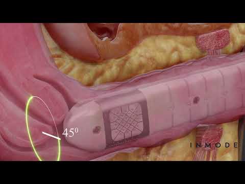 Morpheus8V - How It Works