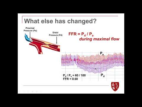 Dr.  Fearon "PCI or CABG for Multivessel CAD  Results of the FAME 3 Trial and more..."