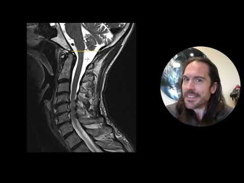 When your MRI is "normal," look at these things! | Cervical Chiropractor Spokane