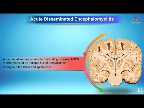 Acute disseminated encephalomyelitis - Neurology