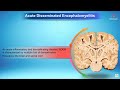 Acute disseminated encephalomyelitis - Neurology