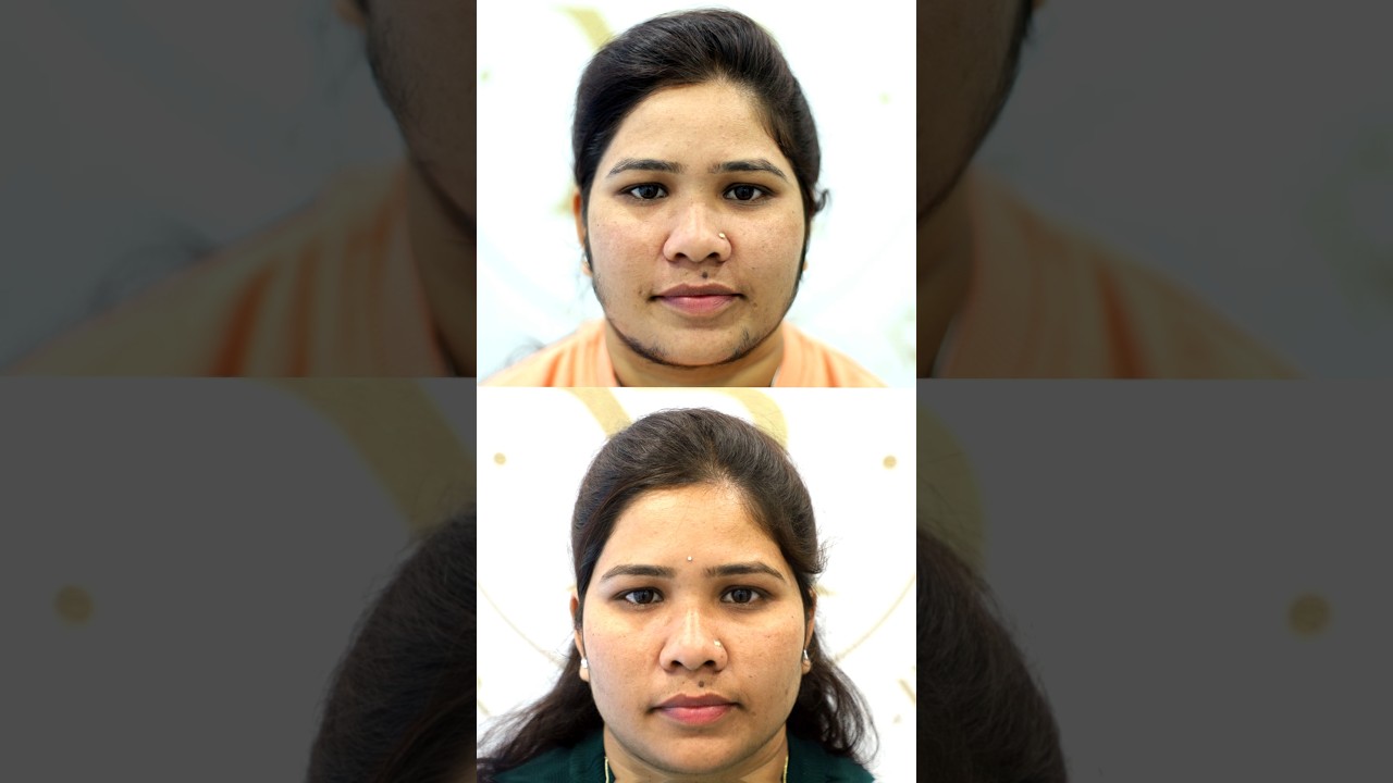 Laser Hair Reduction Treatment: Before & After Results #laserhairreduction #hairremoval #shorts