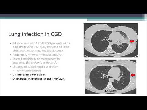 Lung Inflammation/Granuloma Problems with CGD