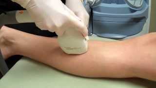LightSheer Duet Laser Hair Removal on a Woman&#39;s Legs