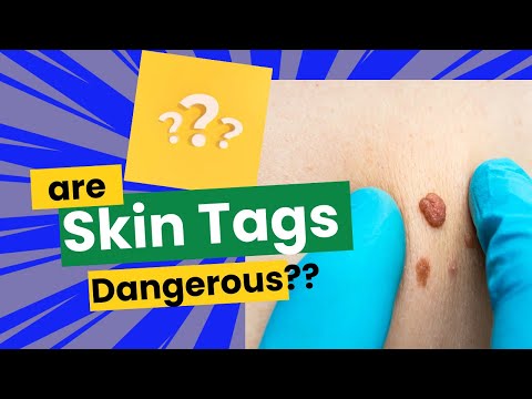 Are Skin tags Dangerous?