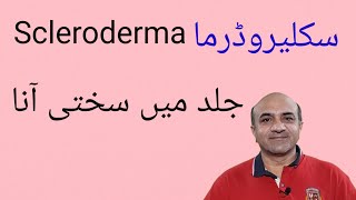 Scleroderma | What Is Scleroderma,Diagnosis & Management