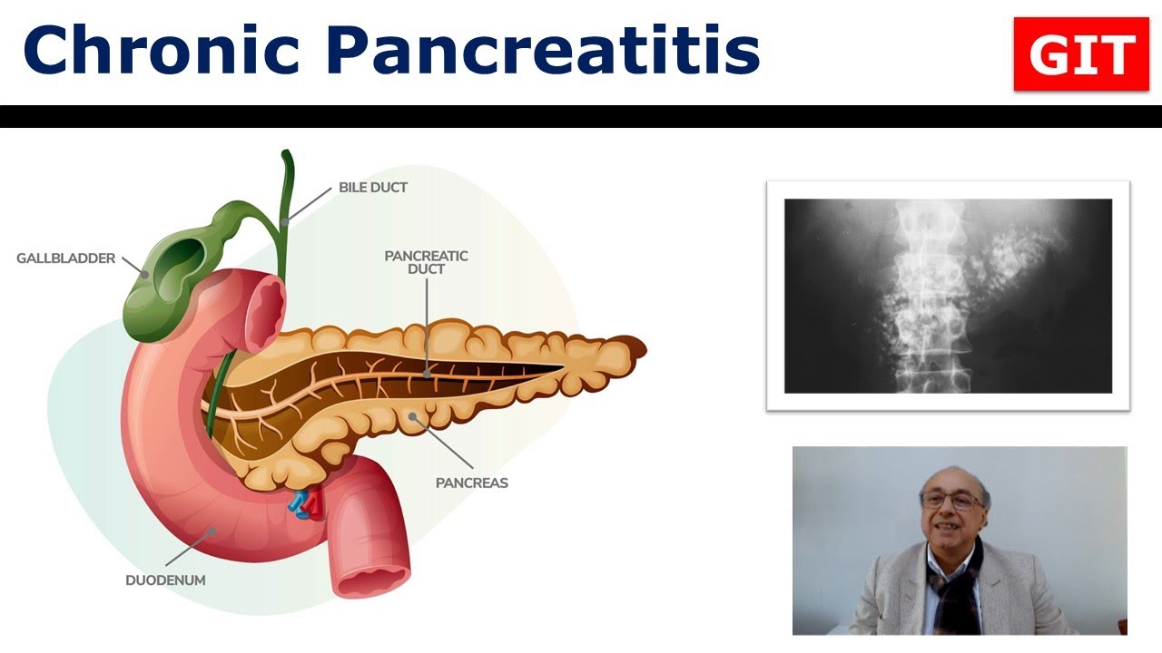 Chronic Pancreatitis (GIT)