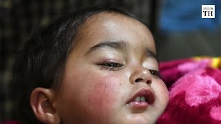 Two-year-old victim in Kashmir brings focus back on pellet guns