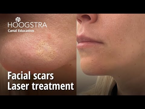 Facial scars - Laser treatment - 22295