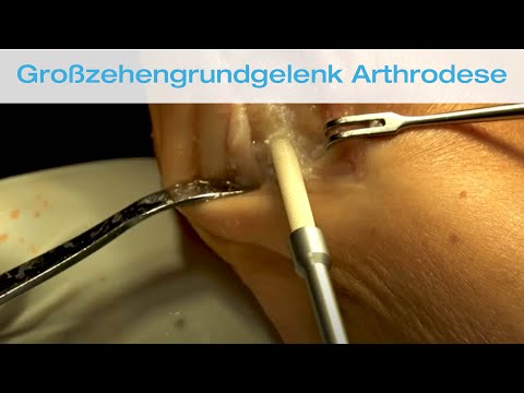 Chirurgie zu ersetzen Gelenke in Kostroma Osteochondrose können Schmerzen im Herzen produzieren