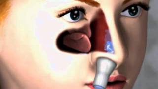 preview picture of video 'Nasaline Junior - Nasal Rinsing System'