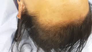 Female SMP Hairline Scalp Micropigmentation by El Truchan @ Perfect Definition