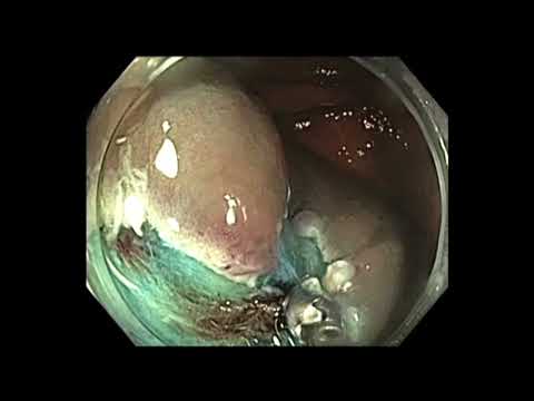 Colonoscopy: Cecal EMR in a patient on chemotherapy for brain tumor