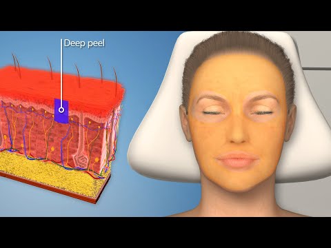 Chemical Peels Explained