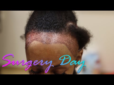Hair Transplant Black Women - Halle's Surgery Day