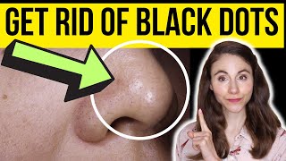HOW TO GET RID OF BLACK DOTS ON THE NOSE | Dermatologist