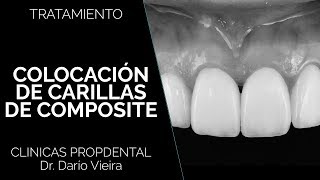Carillas de composite en Propdental