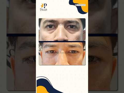 Blepharoplasty Patient Review