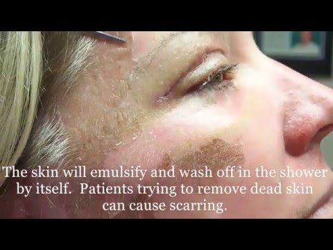 Decolorazione della persona di video Lolio per candeggiare di risposte della pelle di faccia
