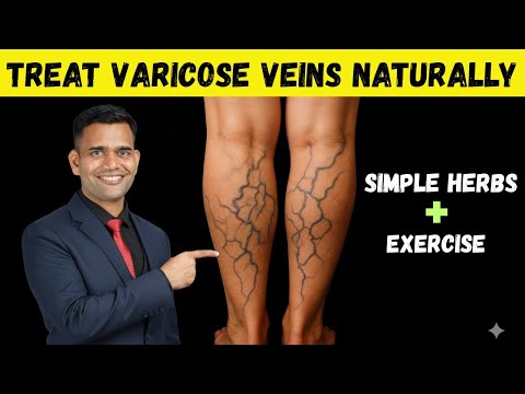 Varicose Veins Can Shrink Naturally? Try This Herb + Exercise