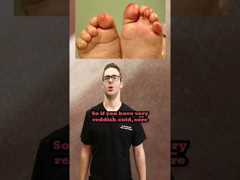 Raynaud s Syndrome When Your Toes Hands or Feet Turn Red or White