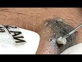 Relax squeezing out blackheads  Spa TV#17 Черные точки