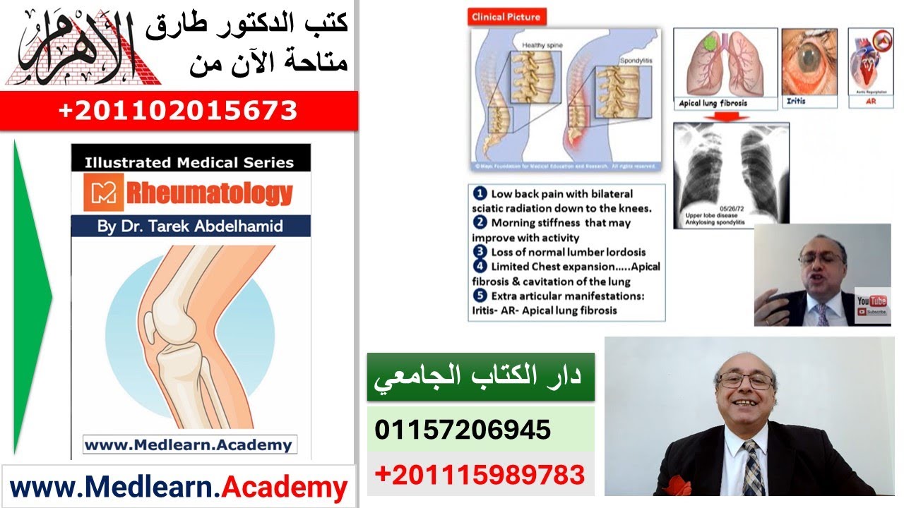 Ankylosing Spondylitis #cme #internal_medicine  #usmle #medicalschool   #medical #محاضرات_باطنة