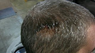 Staples In The Head!!