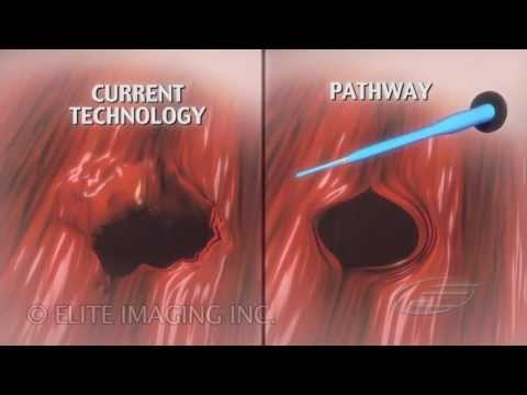 Expandable Introducer - Medical & Scientific Video Production