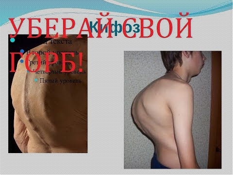Как живут люди со сколиозом 4 степени Нарушения осанки у детей литература