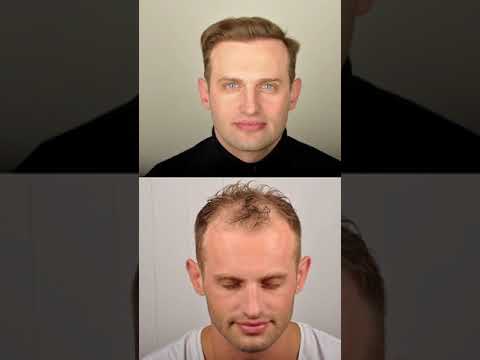 Here is the 6902 grafts FUE (2700 FUE + 4202 FUE) 6 Year Hair Transplant Result