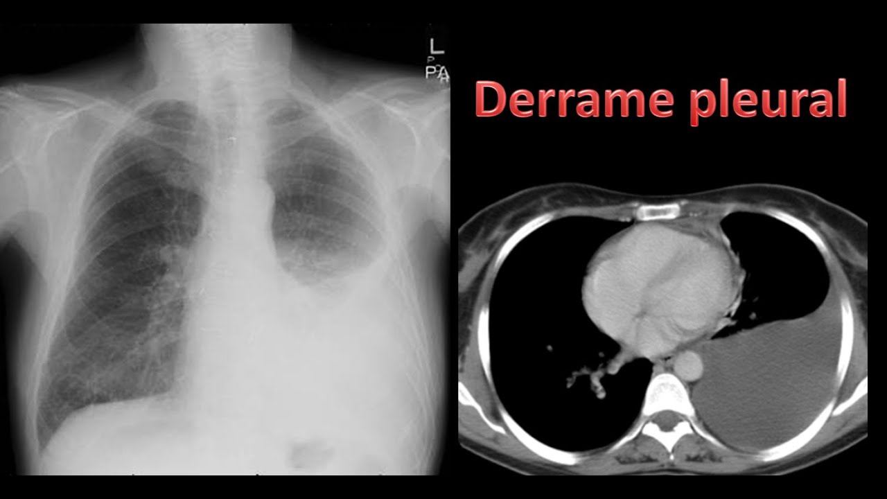 Derrame pleural