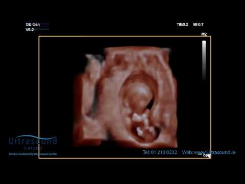 Scan of the Week: 11 Week Early Pregnancy Scan