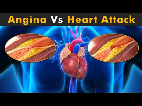 Angina Vs Heart Attack (3D Animation)