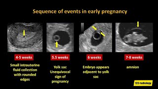 Early Pregnancy Failure, A simplified Ultrasound Approach