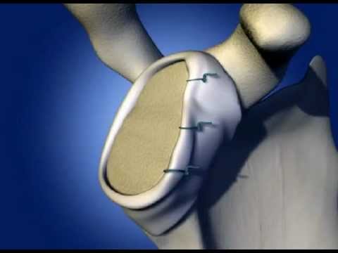 Mal di collo che cazzo Vertigini osteocondrosi orecchio inerente