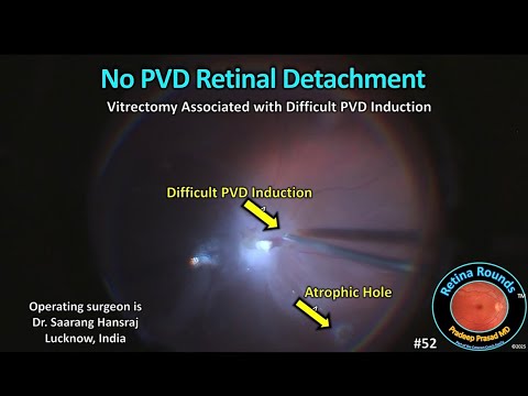 RetinaRounds™ 52: No PVD Retinal Detachment