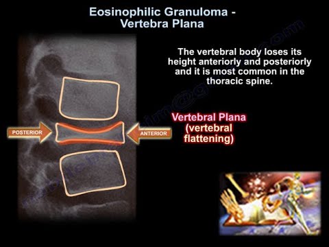 Eosinophilic Granuloma Vertebral Plana - Everything You Need To Know - Dr. Nabil Ebraheim