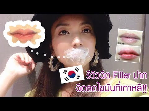 ฉีด ฟิลเลอร์ ปาก