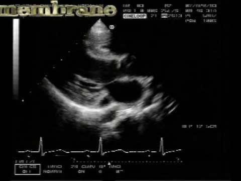 Subaortic Membrane And Coronary Sinus Dilatation