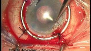 Cirugía combinada: cataratas + transplante de córnea - Instituto de Oftalmología Avanzada