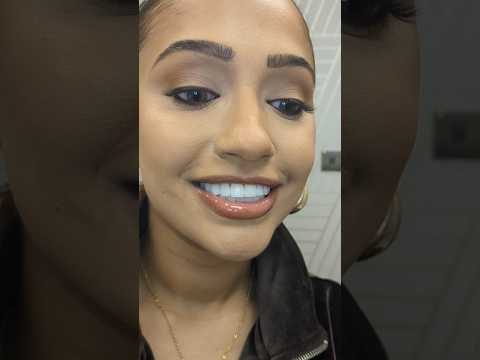 Before and after a full set of composite veneers #veneers #newsmile #teethwhitening #howto #hack