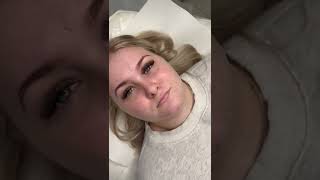 Lip Fillers Before &amp; After: Lip Building with thin Lips